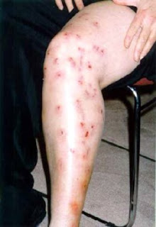 conditions scabies pages treatmentaspx conditions scabies pages treatmentaspx